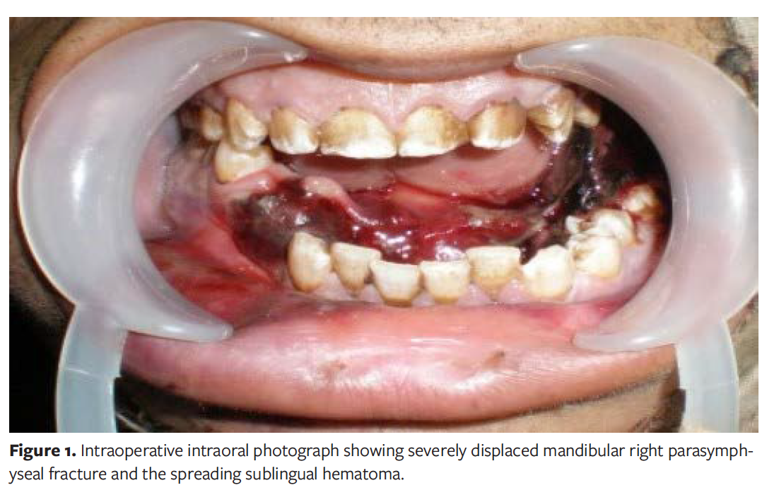 Intraoral Wound Dehiscence After Open Reduction Internal Fixation of